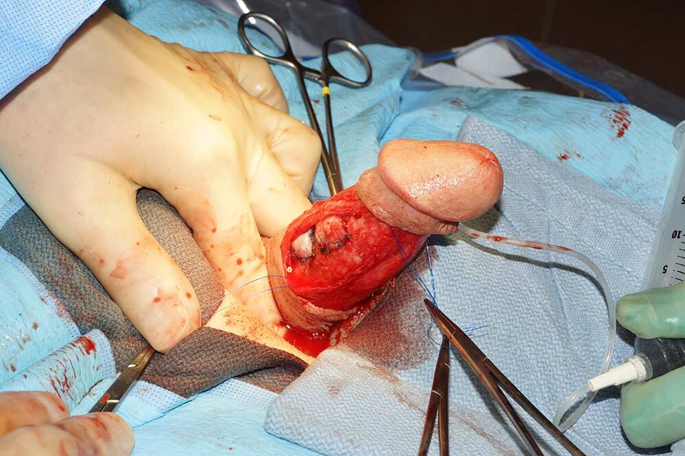 chirurgia dell'ingrandimento del pene
