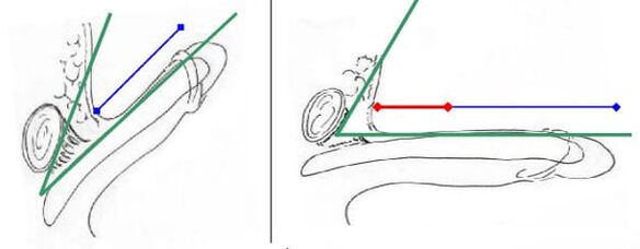Aumento della lunghezza del pene grazie all'intersezione del legamento