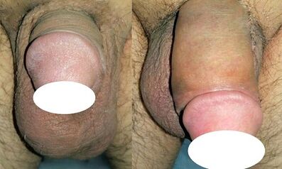 Foto prima e dopo aver aumentato il pene