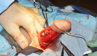 chirurgia dell'ingrandimento del pene