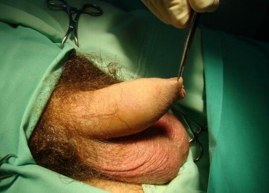 chirurgia per l'ingrandimento del pene